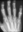 Xray of OA of the Fingers