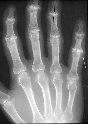 Osteoarthritis of the Fingers X-ray