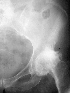 Osteoarthritis of the Hip X-ray