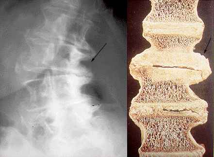 Osteoarthritis of the Spine X-ray