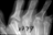 RA of the Hands Xray