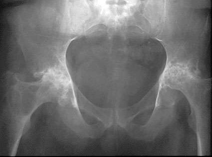 Rheumatoid Arthritis X-ray
