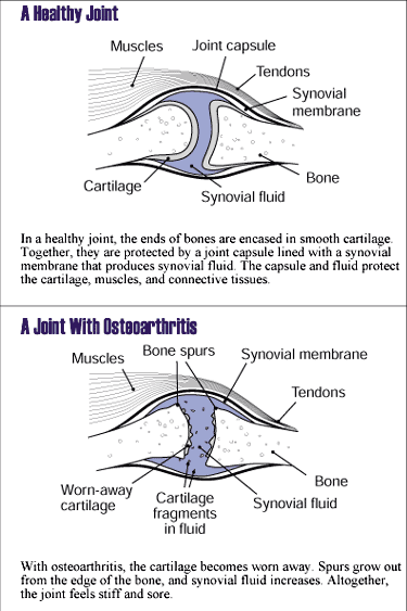 images of a healthy joint, and a joint with osteoarthritis